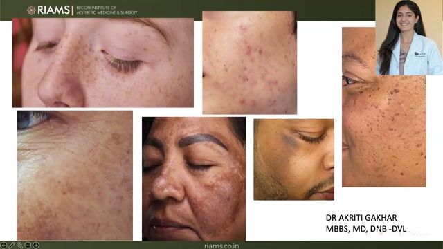 Melasma: Diagnosis & Management